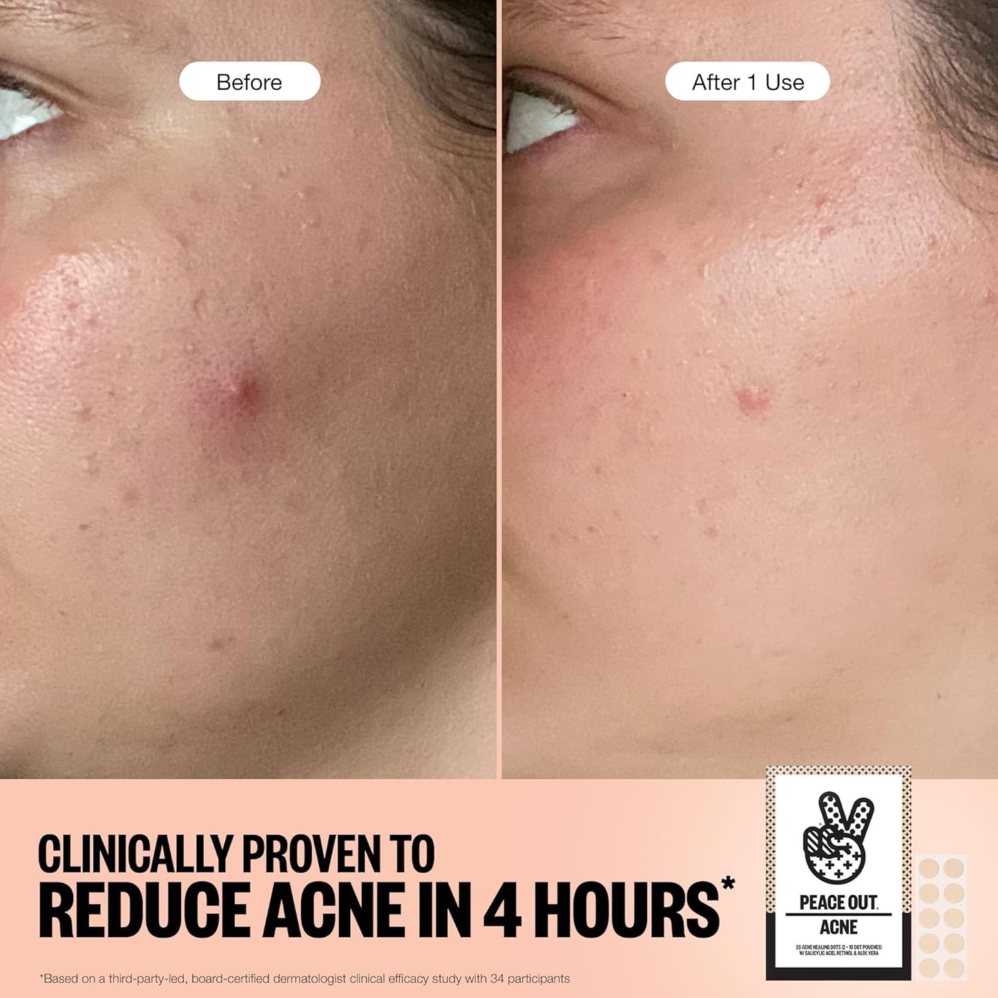 Acne Healing Dots Hydrocolloid Pimple