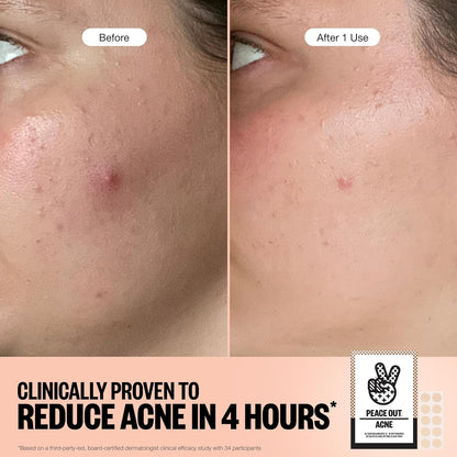 Acne Healing Dots Hydrocolloid Pimple