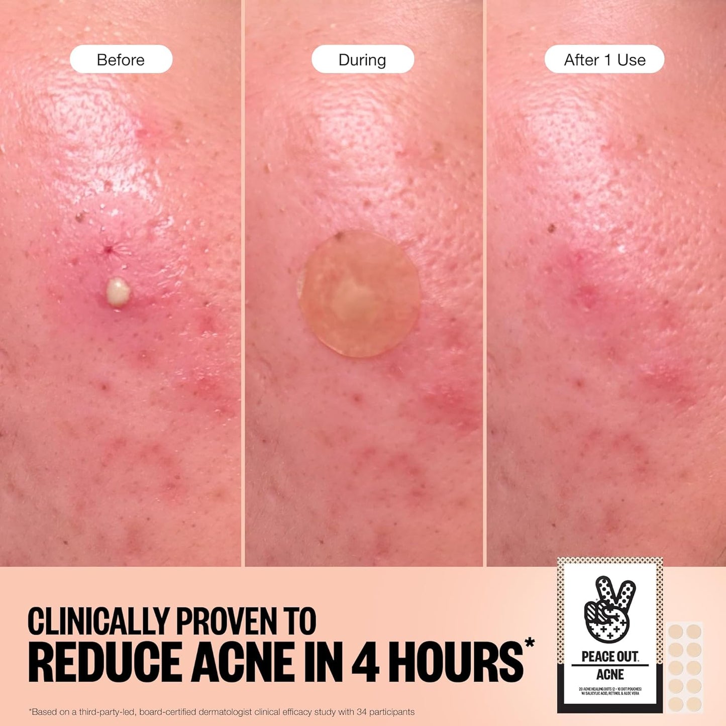 Acne Healing Dots Hydrocolloid Pimple