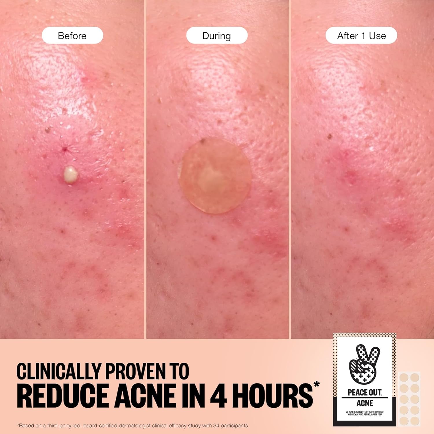 Acne Healing Dots Hydrocolloid Pimple