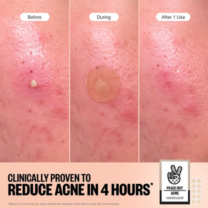 Acne Healing Dots Hydrocolloid Pimple